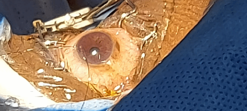 Augmented Trabeculectomy accelerated video